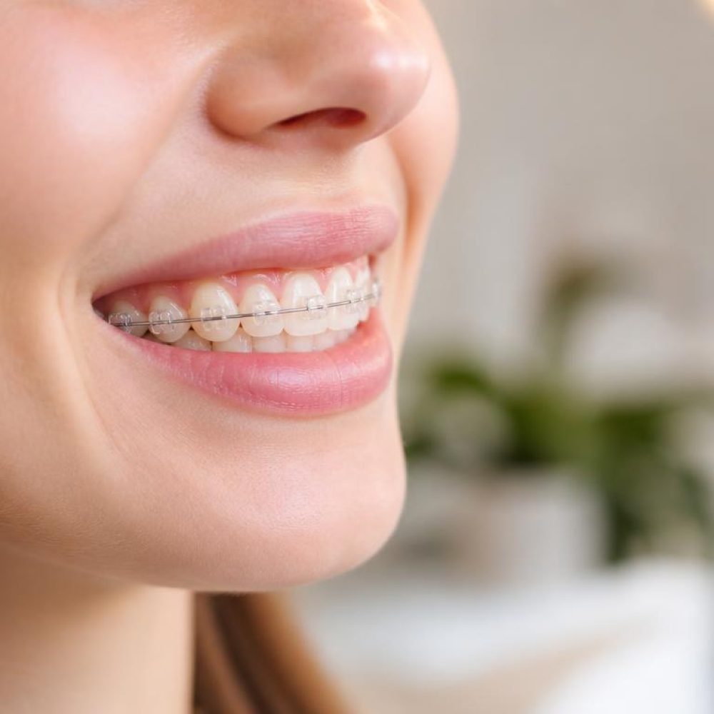 treatment-fixed-braces-C9p_wPqA